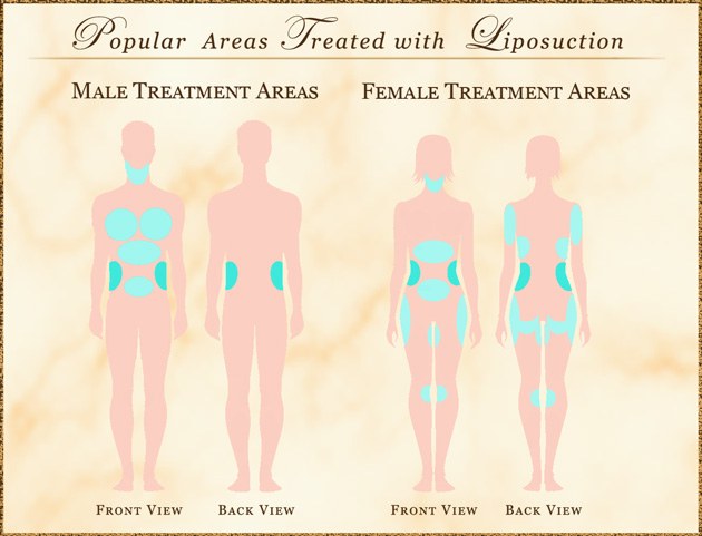 Risks & Complications of Liposuction