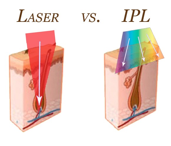 Laser vs Intense Pulsed Light (IPL)