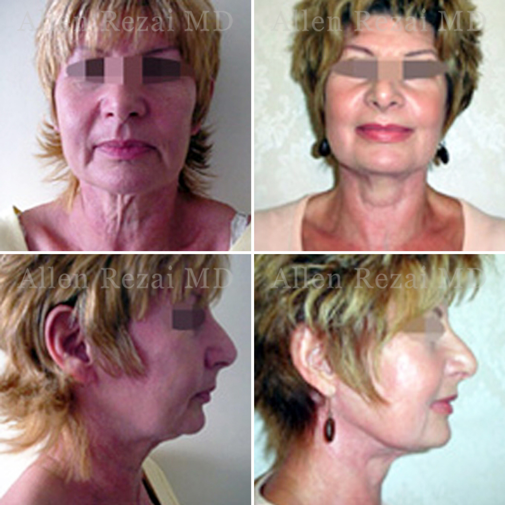 Facelift / Neck Lift  Best Plastic & Cosmetic Surgery Clinic