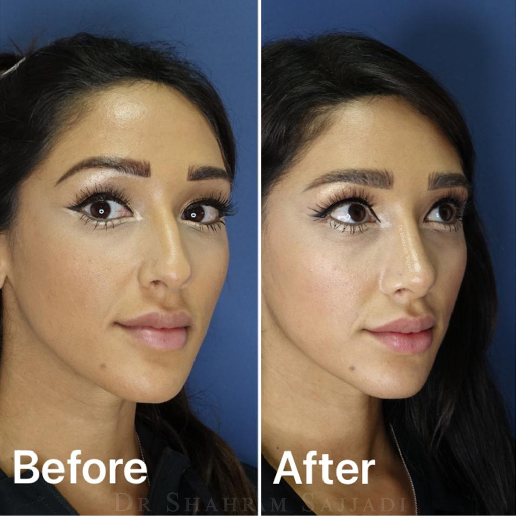 Rhinoplasty Ultrasonic Rhinoplasty Best Plastic Cosmetic