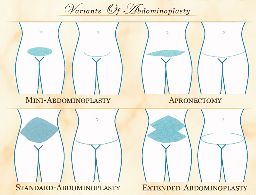 Tummy Tuck (Abdominoplasty)  Best Plastic & Cosmetic Surgery