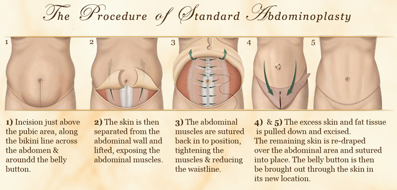 Abdominoplasty: What Is It and How Does It Change Your Body? - Bellezie