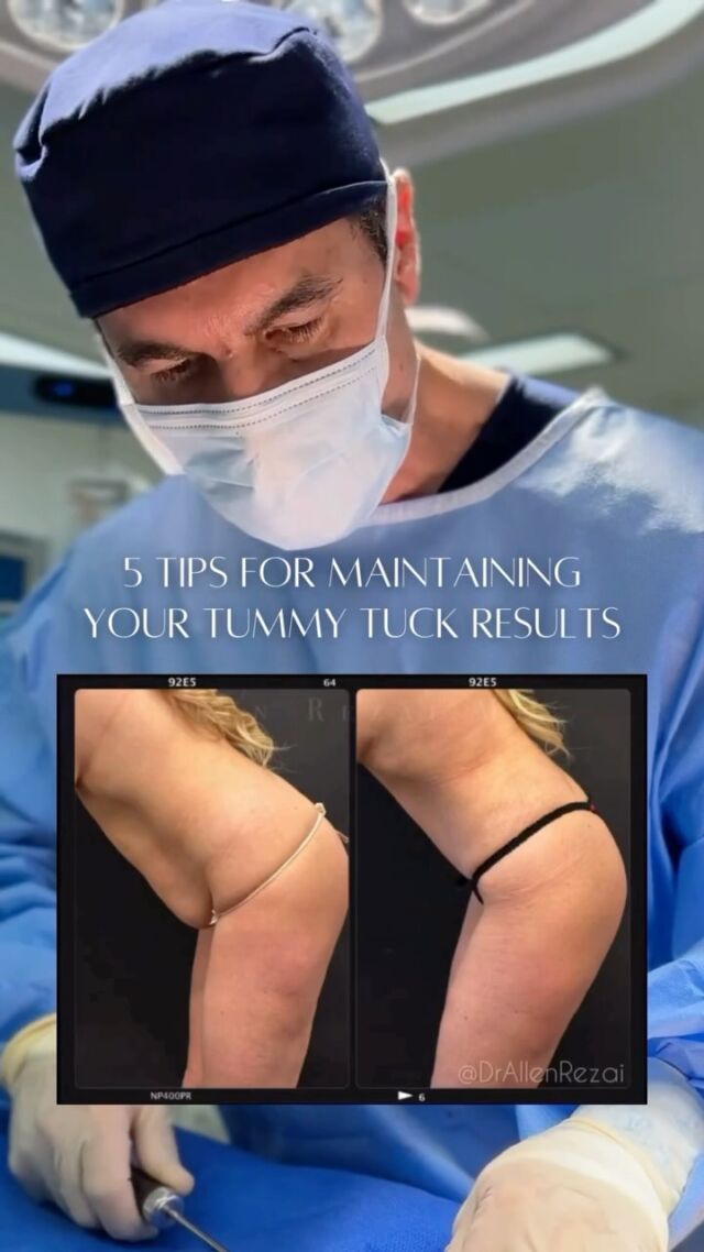 A tummy tuck can be a life-changing procedure, but maintaining and prolonging your results requires consistent care. Here are a few essential tips for a speedy recovery and maintaining the results of your tummy tuck :

• Follow Post-Op Instructions: Carefully adhere to @DrAllenRezai’s guidance for a smooth recovery and long-lasting results.
• Maintain a Stable Weight: Avoid significant weight fluctuations to preserve your toned appearance.
• Eat a Healthy, Balanced Diet: Focus on nutrient-rich foods to support skin health and overall wellbeing.
• Stay Active: Regular exercise, especially core strengthening, helps maintain muscle tone and definition.
• Plan Future Pregnancies Wisely: For best results, wait until you’ve completed your family before undergoing a tummy tuck.

Detailed Consultation, Bespoke Treatment Plan and AfterCare, are key in achieving the Best possible Outcome for You.

⚜️For Enquiries or to schedule a consultation Contact Your Preferred Clinic:

🇦🇪#Dubai @EliteClinicDubai
📞+971 (0)4431 2396

🇬🇧#London & #EastSussex @DrAllenRezai @SkinCision_Clinic
📞+44 (0)20 7580 8001
•
#EliteClinicDubai #DrAllenRezai #DrAllenDubai #abdominoplasty #bodycontouring #minituck #mommytuck #vaserLipo #liposuction #renuvion #jplasma #skintightening #PlasticSurgery #vaserliposuction #mummymakeover #mommymakeover #bodyreshaping #liposuctiondubai #lipolaser #skintighteningtreatment #dubailife #adudhabilife