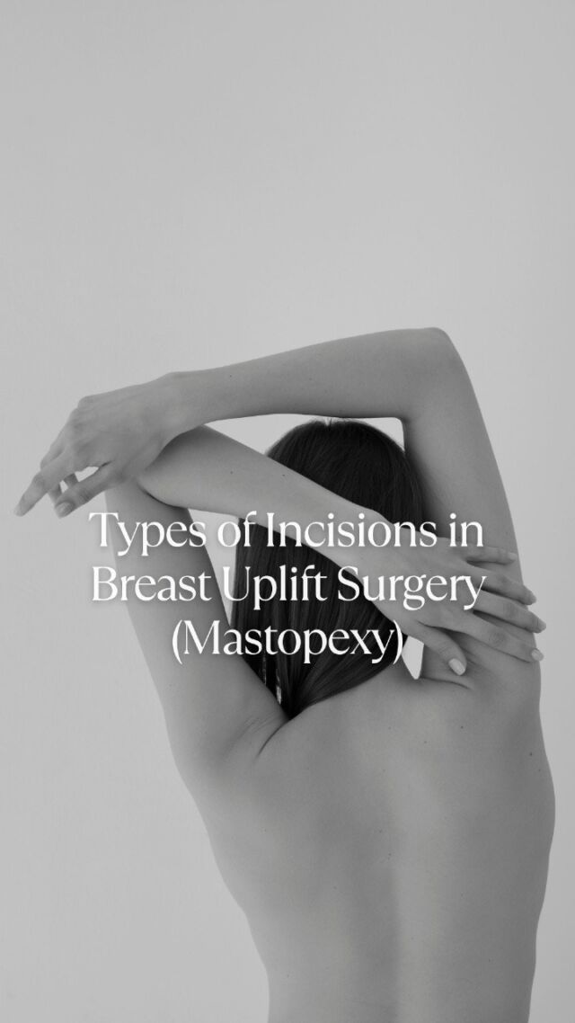 Breast Uplift surgery with @DrAllenRezai is never one-size-fits-all. The type of incision used is carefully chosen based on your anatomy, degree of sagging (ptosis), and the desired lift and shape. Here are the most common types:

👉🏻 Periareolar (Donut) – Around the areola. Suitable for mild lifting and minor reshaping.
👉🏻 Vertical (Lollipop) – Around the areola and down to the crease. Ideal for moderate sagging.
👉🏻 Inverted-T (Anchor) – Around the areola, vertically down, and along the breast crease. Best for significant lifting and reshaping.

Each incision type is designed to heal discreetly over time. A skilled surgeon places them strategically to blend into the natural contours of the breast.

✳️ Remember: The incision is just one part of the plan. A beautifully shaped breast comes from careful design and surgical expertise.

@DrAllenRezai will guide you towards the best possible options for your particular anatomy, aesthetic goals, and personal circumstances. Schedule an appointment today.

☎️ +971 4 431 2396 | +971 52 892 8353
📩 info@elitecosmeticsurgery.ae
•
#EliteClinicDubai #DrAllenRezai #BreastSurgery #BreastAugmentation #BodyPositivity #Reduction #BreastUplift #BreastLift #Mastopexy #BreastLiftWithImplants #DrAllenAnswers #BreastReductionSurgery #PlasticSurgery #DubaiAesthetics #BreastSurgeryDubai #BreastEnhancement #NaturalLook #DubaiLife #AbuDhabiLife #Confidence #BodyPositivity #BestPlasticSurgeonDubai #DubaiWomen #MiddleEast #DubaiLife