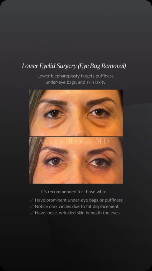 Your eyes might be telling a story that doesn’t match how you feel. Drooping lids, puffiness, or sagging skin can give the impression of fatigue or ageing, even when you’re well-rested and energised.

Blepharoplasty (#EyelidSurgery) offers a tailored solution to rejuvenate the upper and/or lower eyelids by removing excess skin, fat, or muscle to restore a refreshed, more youthful appearance.

Types of Eyelid Surgery:
✔️ Upper Blepharoplasty – lifts sagging upper lids, improves vision and contour
✔️ Lower Blepharoplasty – addresses under-eye bags and puffiness
✔️ Upper + Lower – comprehensive rejuvenation
✔️ Double Eyelid Surgery – creates a defined eyelid crease for enhanced symmetry

An initial thorough consultation, correct technique & surgical planning are key in achieving the best possible outcome for YOU. Book a detailed consultation with @DrAllenRezai now.

☎️ +971 4 431 2396 | +971 52 892 8353
📩 info@elitecosmeticsurgery.ae
•
#EliteClinicDubai #DrAllenDubai #DrAllenRezai #EyelidSurgery #UpperBlepharoplasty #LowerBlepharoplasty #Blepharoplasty #PlasticSurgery #CosmeticSurgeryDubai #LifeChangingJourney #DroopyEyelids #EyebagRemoval #Transformation #DubaiLife #AbuDhabiLife