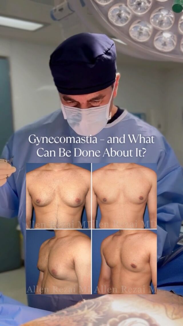 MALE CHEST REDUCTION // Gynecomastia is More Common than You Might Think!

Male Chest Reduction, also known as Gynecomastia surgery involves liposuction of the fatty tissue and excision of glands where applicable. Undergoing #MaleChestReduction is a very personal decision and should not be based on the expectations of others. Detailed Consultation, Correct Surgical Technique & Planning are Key in Achieving the best possible outcome for you!

☎️ +971 4 431 2396 | +971 52 892 8353
📩 info@elitecosmeticsurgery.ae
•
#DrAllenRezai #DrAllenDubai #EliteClinicDubai #MaleChestReduction #ManBoobs #Gynecomastia #MaleBreastReduction #PlasticSurgeon #chestday #breastsurgery #Plasticsurgery #NaturalResults #dubaifitness #dubailife #liposuction #chestliposuction #malechest #breastreduction #dubaipersonaltrainer #menstyle #plasticsurgerybeforeandafter