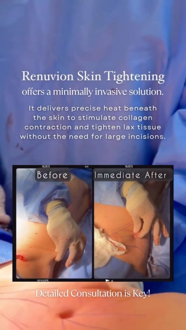 Loose skin in the abdominal area is a common concern—often following pregnancy, significant weight loss, or as a result of natural ageing and reduced skin elasticity.

✨ Renuvion J-Plasma offers a modern, minimally invasive solution. By combining helium plasma and radiofrequency energy, it delivers precise heat beneath the skin to stimulate collagen contraction and tighten lax tissue—without the need for large incisions.

The outcome? Smoother, firmer skin and improved contour with minimal downtime and no visible scarring.

Renuvion is especially effective for mild to moderate skin laxity and is often performed in combination with liposuction to enhance overall body shaping and definition. Schedule an initial thorough consultation with @DrAllenRezai and determine your suitability for this procedure.

☎️ +971 4 431 2396 | +971 52 892 8353
📩 info@elitecosmeticsurgery.ae
•
#EliteClinicDubai #DrAllenRezai #DrAllenDubai #VaserLipo #Renuvion #RenuvionJPlasma #Liposuction #Jplasmarenuvion #skintighteningtreatment #PlasticSurgery #vaserliposuction #bodycontouring #mummymakeover #liposuctiondubai #breastaugmentation #breastimplants #cosmeticsurgery #jplasmadubai #doublechin #mydubai #plasticsurgerybeforeandafter #looseskin #tightenskin #skintightening