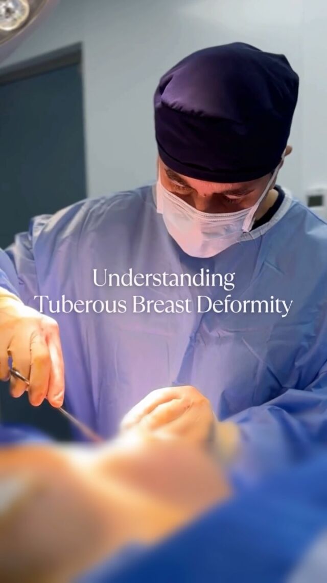 Tuberous Breast Deformity is a congenital condition that can significantly impact the shape, volume, and overall appearance of the breasts.

Common signs may include:
• Irregular or asymmetrical shape
• Constricted, narrow base
• Sagging or drooping appearance
• Puffy, enlarged areolas
• Downward-pointing nipples
• Noticeable gap between the breasts (wide cleavage)

This condition is more common than many realise—and often goes undiagnosed.
A thorough initial consultation with @DrAllenRezai will help determine whether you're affected by Tuberous Breast Deformity and guide you through the available treatment options.

☎️ +971 4 431 2396 | +971 52 892 8353
📩 info@elitecosmeticsurgery.ae

#EliteClinicDubai #DrAllenRezai #DrAllenDubai #BreastSurgery #TuberousBreastDeformity #TuberousBreastCorrection #TubularBreasts #TuberousBreast #BreastReshaping #BreastReconstruction #BreastUplift #BreastAugmentation #BreastSculpting #LifeChangingJourney #UpliftedConfidence #DubaiLife #AbuDhabiLife #DubaiWomen