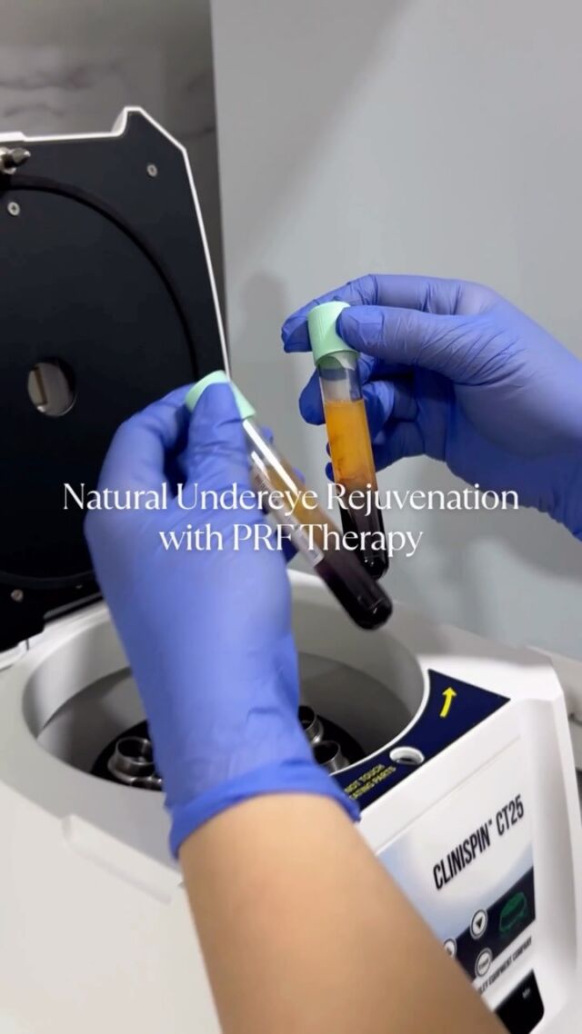 ❤️ 3 reasons why our patients love #PRF Therapy for Undereye Rejuvenation:

1. All-Natural Approach – much like PRP, PRF is extracted from your own blood and is used to enhance collagen production, skin tightening & overall rejuvenation of the skin in the lower eyelid.
2. Quick Procedure with No Downtime – the full procedure takes approximately 45 minutes and patients can return to their normal daily life following the treatment.
3. Safe, effective & can be used in combination with other treatments such as Radio Frequency Microneedling.

Determine your suitability for PRP/PRF Therapy. Schedule a detailed consultation with @DrAllenRezai.

☎️ +971 4 431 2396 | +971 52 892 8353
📩 info@elitecosmeticsurgery.ae
•
#EliteClinicDubai #DrAllenRezai #PRF #PlateletRichFibrin #PRFInjections #PRFTreatment #UndereyePRFInjection #EyeRejuvenation #FacialRejuvenation #Eyebag #UndereyeDarkness #DubaiAesthetics #Aesthetic #Injectables #PRP #PRPTreatment #PlastiSurgeon #PlasticSurgeryDubai #DubaiLife #AbuDhabiLife #Fillers #Botox #Profhilo #SkinBooster #SkinRejuvenation