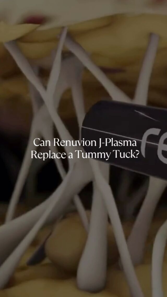 Renuvion J-Plasma is an advanced skin-tightening technology that uses a combination of helium plasma and radiofrequency energy to contract collagen and firm the skin from within.

While effective for mild to moderate skin laxity, Renuvion does NOT remove excess skin or repair abdominal muscle separation. For patients with significant laxity, loose skin, or diastasis recti, a tummy tuck (#abdominoplasty) remains the most appropriate solution.

Choosing between Renuvion and tummy tuck depends entirely on your anatomy, goals, and clinical assessment.

Detailed Consultation, Bespoke Treatment Plan and AfterCare, are key in achieving the Best possible Outcome for You. Schedule an initial thorough consultation with @DrAllenRezai and determine which procedure suits your need.

☎️ +971 4 431 2396 | +971 52 892 8353
📩 info@elitecosmeticsurgery.ae
•
#EliteClinicDubai #DrAllenRezai #DrAllenDubai #VaserLipo #Renuvion #RenuvionJPlasma #Liposuction #Jplasmarenuvion #skintighteningtreatment #PlasticSurgery #vaserliposuction #bodycontouring #mummymakeover #liposuctiondubai #breastaugmentation #breastimplants #cosmeticsurgery #jplasmadubai #doublechin #mydubai #plasticsurgerybeforeandafter #looseskin #tightenskin #skintightening
